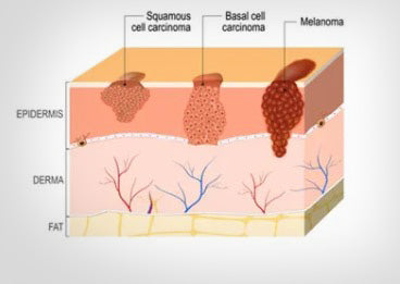 Melanoma