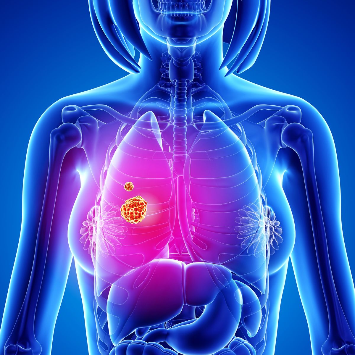 iSelfTest Lung Cancer Risk